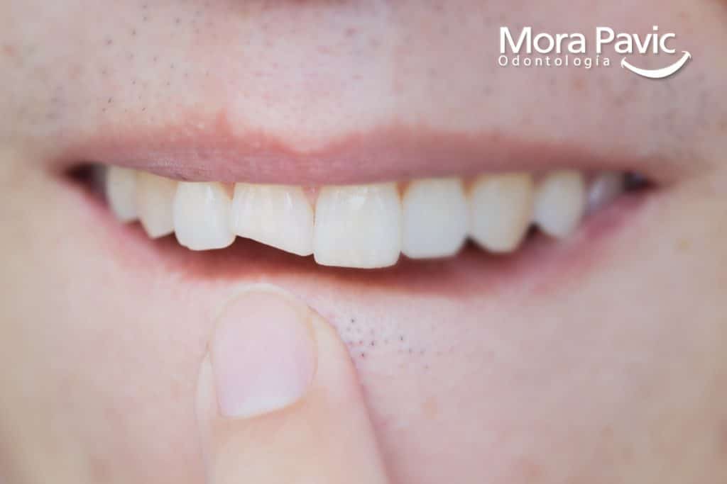 Rehabilitacion Oral