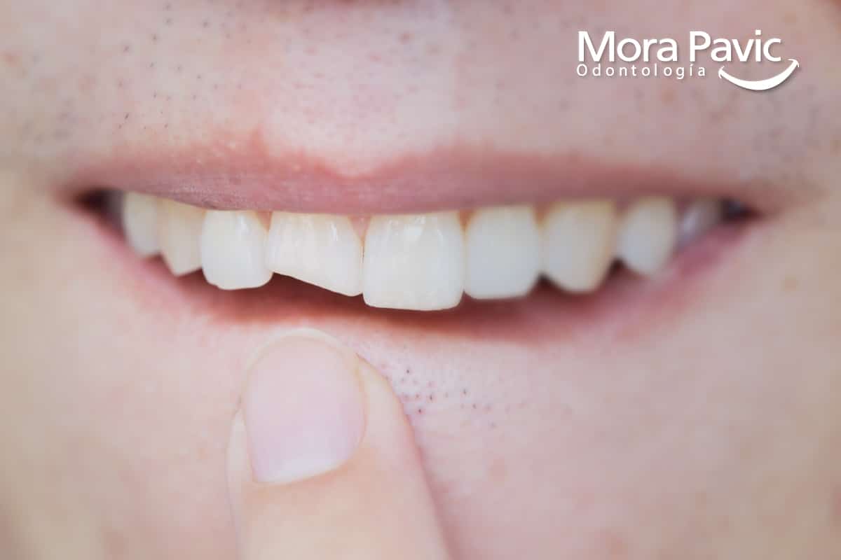 Rehabilitacion Oral
