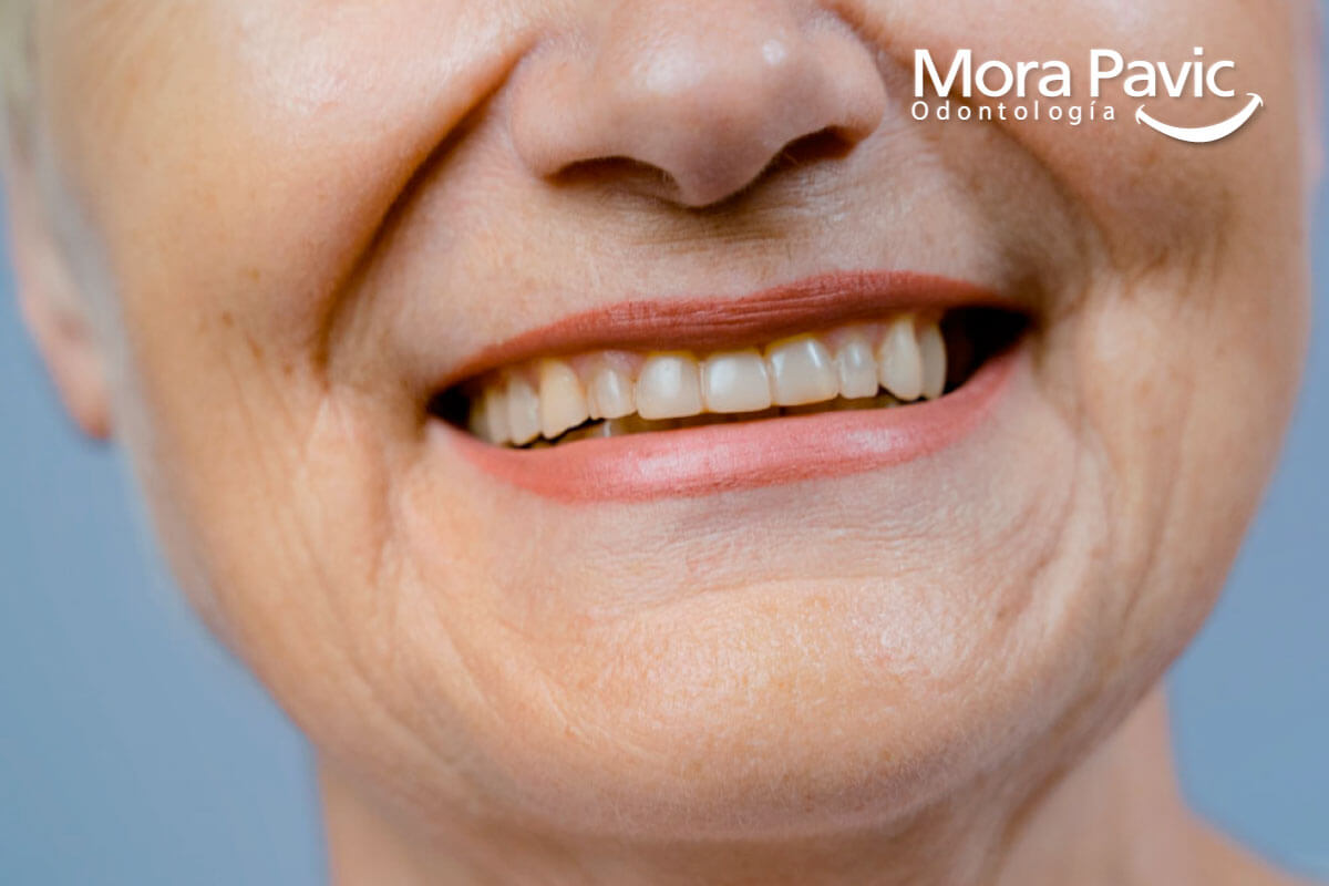 Dientes manchados