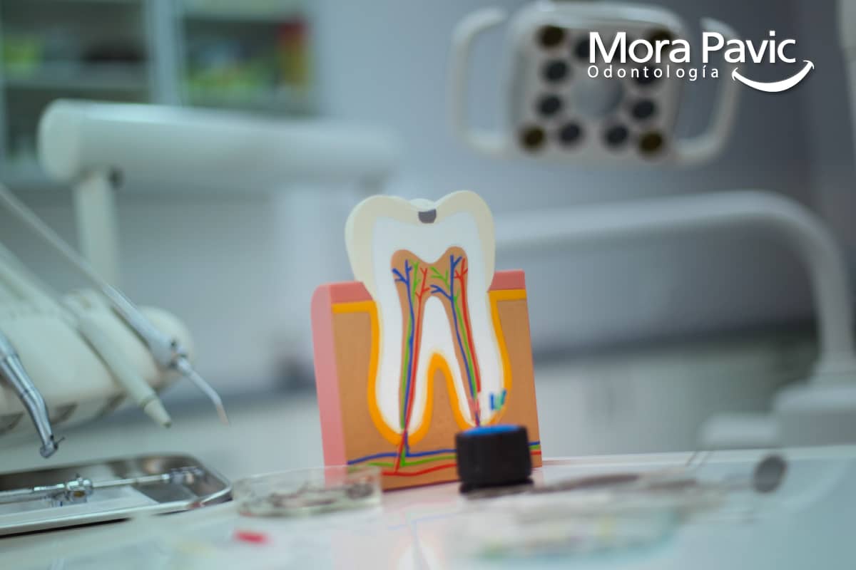 Que es una endodoncia