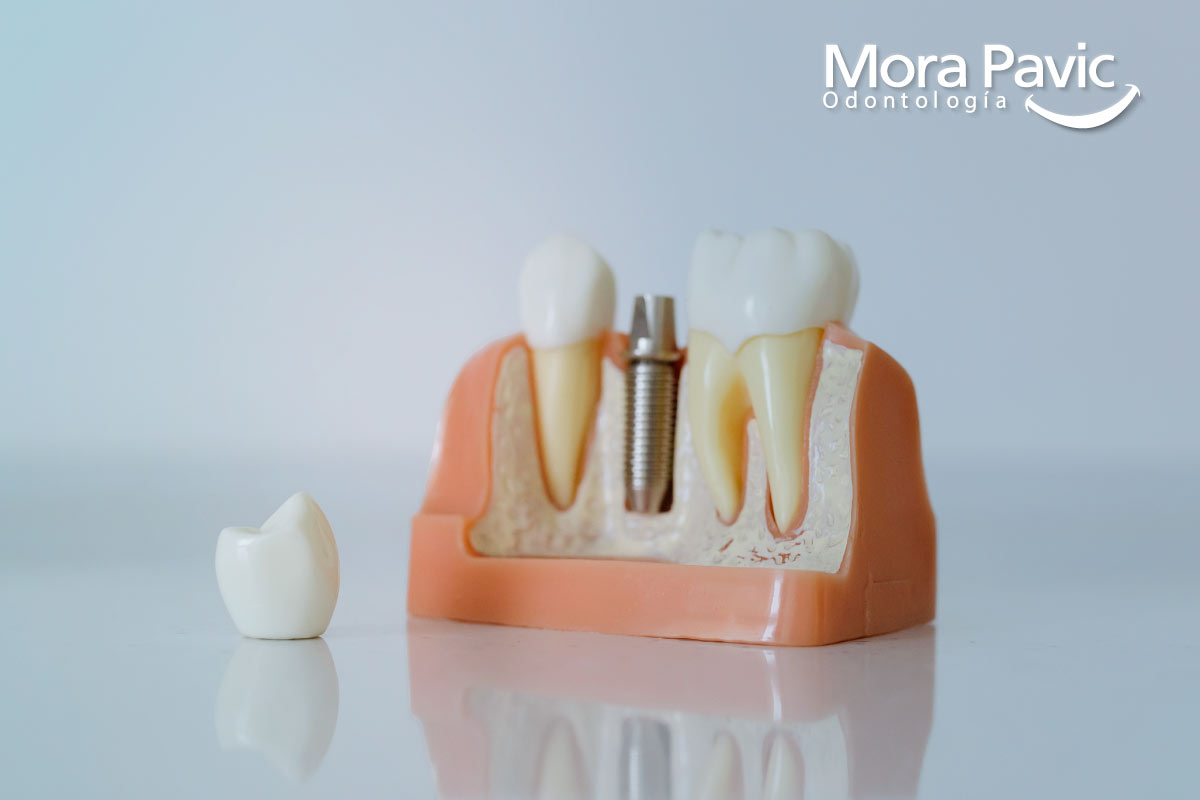 Implantes dentales