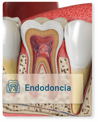 Especialista realizando endodoncia para aliviar dolor dental
