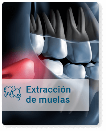 Extracción de muela del juicio por dentista especializado
