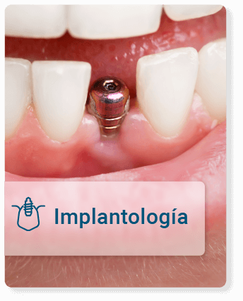 Implante dental para restaurar sonrisa y funcionalidad