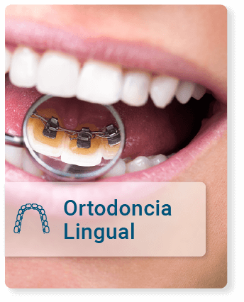 Tratamiento de ortodoncia lingual, brackets discretos en la parte interna