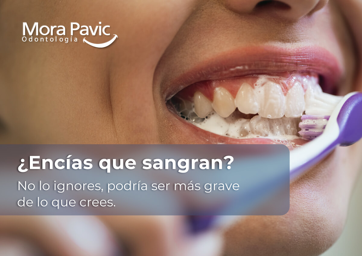 El sangrado de encías: causas, riesgos y cuándo acudir al dentista