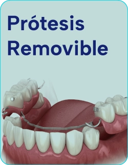 Tratamientos-con-protesis-removible