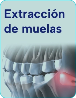 Tratamientos-de-Extraccion--de-muelas