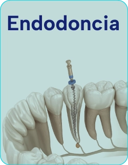 Tratamientos-de-endodoncia