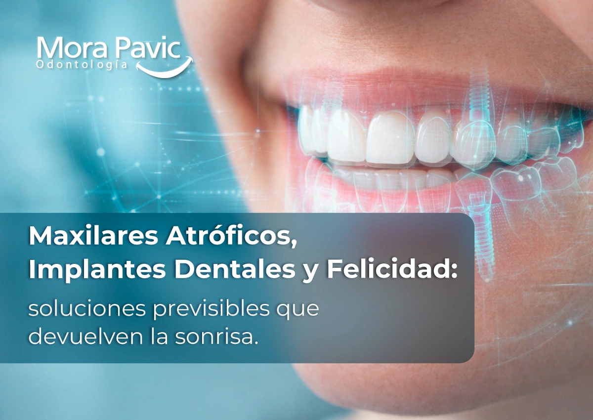 Recupera tu sonrisa con Implantes dentales en maxilares atróficos